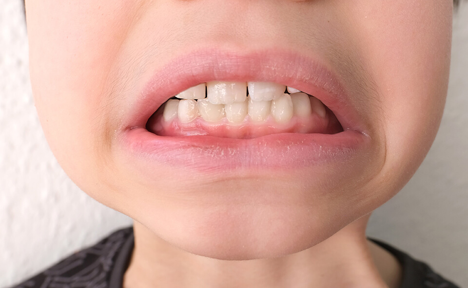 Teeth Straightening