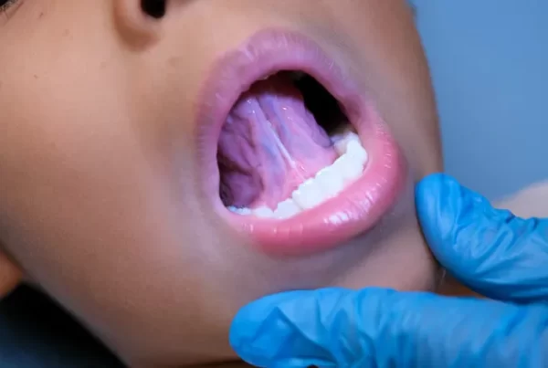 Treatment for Babies with Oral Tethering