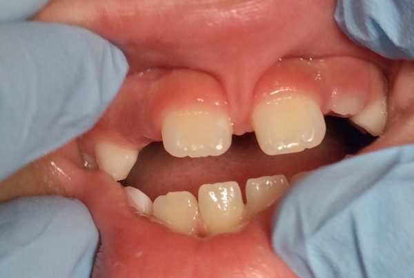 Pediatric Lip Tie Issue