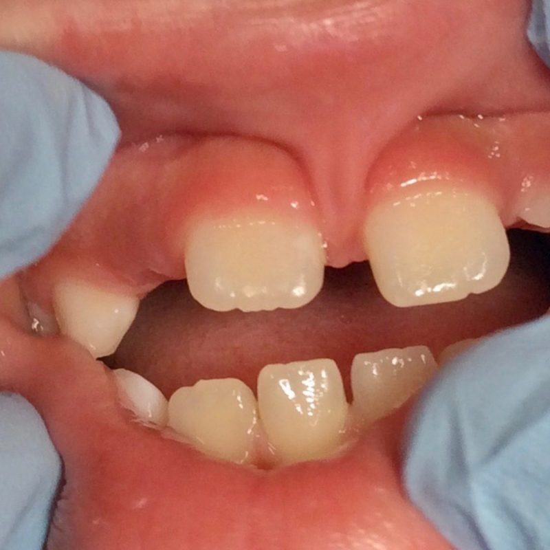 Pediatric Lip Tie Issue